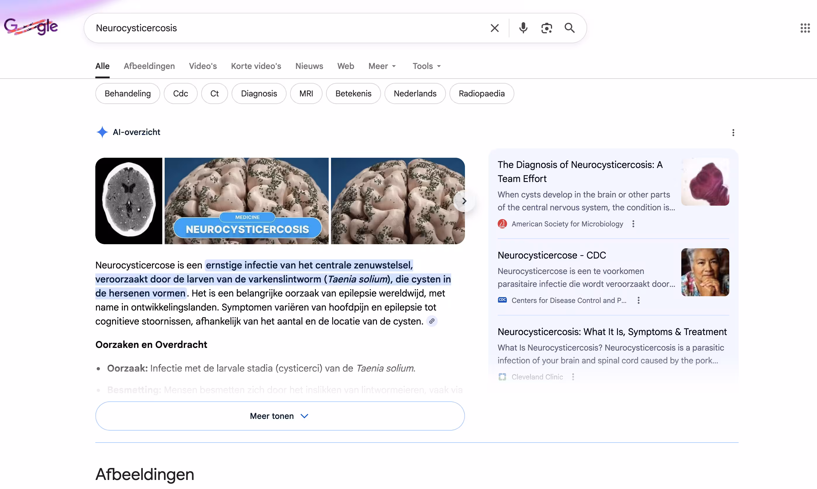 Google Search results for Neurocysticercosis